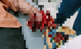 Tangan Pria di Kendari Hancur Kena Ledakan Petasan