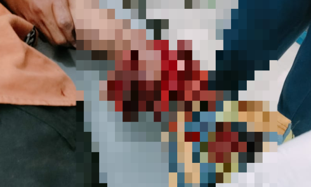 Tangan seorang warga Kota Kendari hancur terkena ledakan petasan rakitan di Desa Sorue Jaya, Kecamatan Soropia, Kabupaten Konawe, Sabtu (31/12/2022).